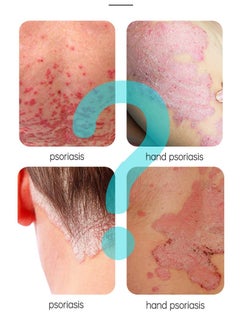 JoyPretty 2-PACKS Psoriasis Relief Cream , Anti-Bacterial Moisturizer for Scaly Skin & Redness – Natural Herbal Cream for Eczema, Dermatitis, Psoriasis, and Vitiligo – Unisex (20g*2)  - Image 3