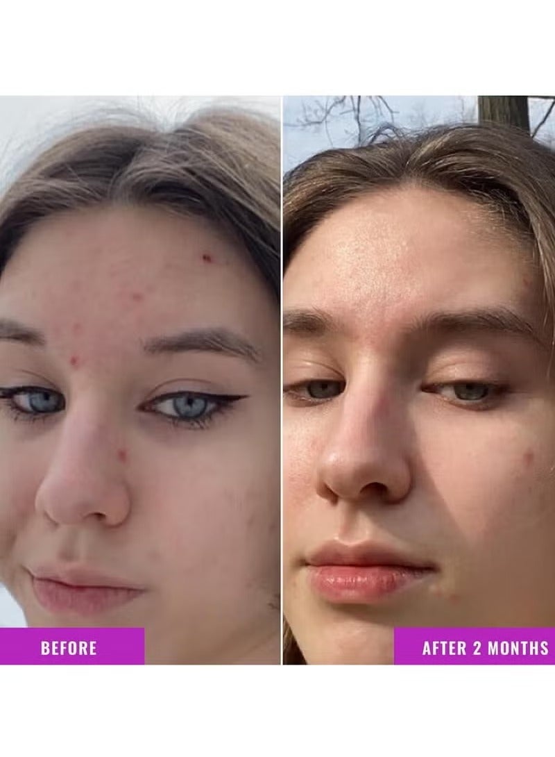 Good Molecules Niacinamide Serum - 10% Niacinamide Balancing B3 Facial Serum for Acne, Tone, Texture - Brightening and Hydrating Skincare for Face - Image 4