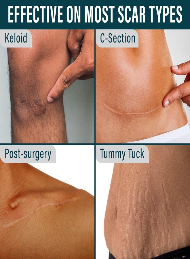 NUVADERMIS Clear Silicone Scar Tape for Surgical Scars - 120" x 1.5" Rolls - Section, Tummy Tuck, Keloid, and Surgical Scars - Reusable Medical Grade Silicone Scar Tape - Pack of 2 - Image 3