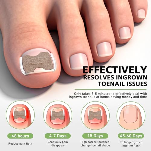 BALUCA 2025 Upgraded Ingrown Toenail Corrector Kit | Professional Ingrown Toenail Treatment & Pain Relief | Home Pedicure Tool Set with Breathable Corrector Strips & Toenail Tools - Image 2