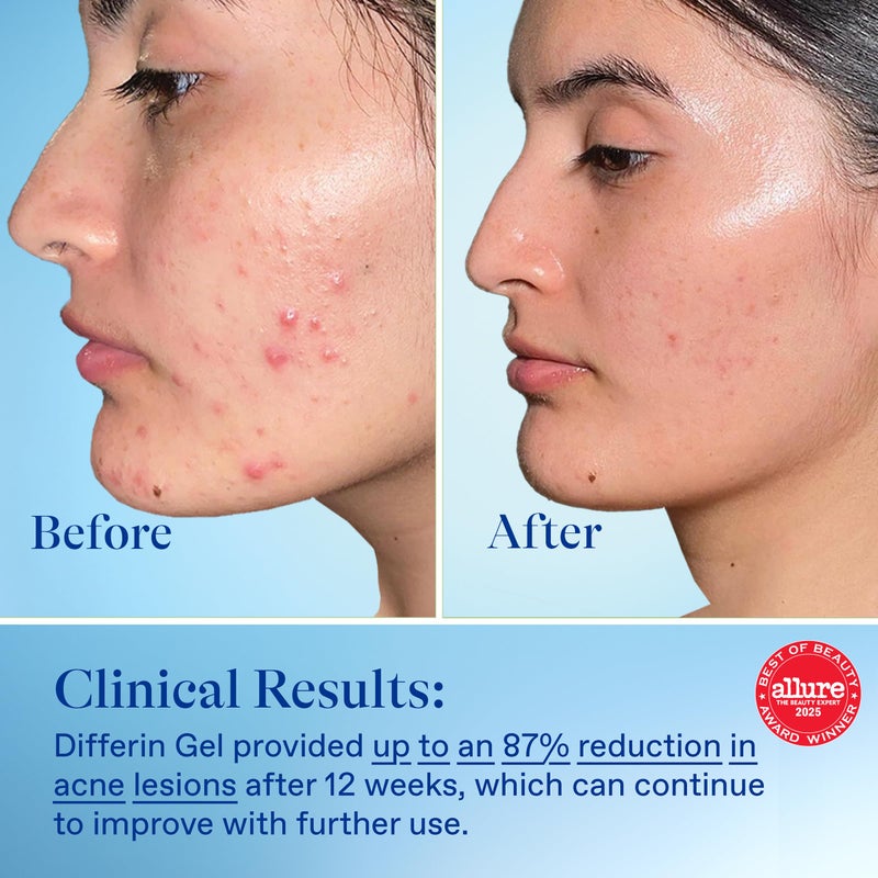 Differin Acne Treatment Gel, 60 Day Supply, Retinoid Treatment for Face with 0.1% Adapalene, Gentle Skin Care for Acne Prone Sensitive Skin, 15g Tube (Pack of 2) (Packaging May Vary) - Image 5