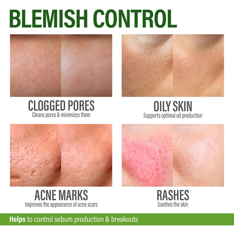 GRAMRIGHT Acne Face Cream - Acne Spot Treatment for Face & Acne Dots - Tea Tree Oil & Salicylic Acid - Natural Cystic Acne Treatment - Made in USA - For All Skin Types - Acne Scar Cream & Pimple Remover 4 fl.oz - Image 4