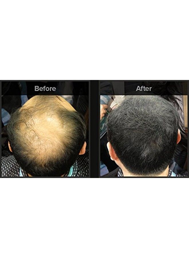 Fix-O-Fit Hair Fibers Dark Brown For Men And Women Natural Hair Thickening Fiber 22G - Image 4
