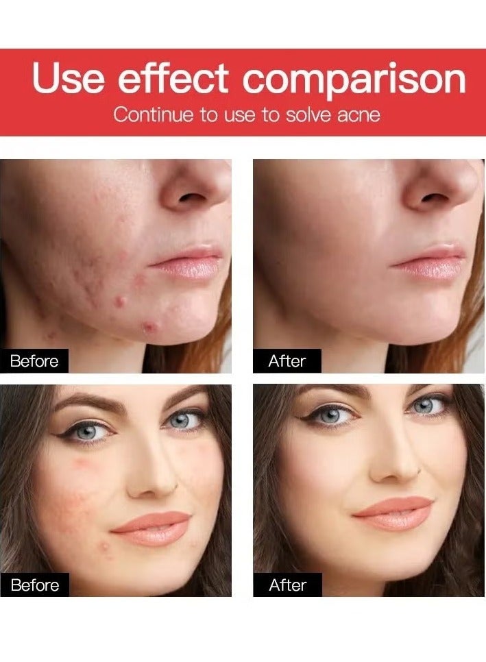 Invisible Acne Pimple Patch Set Clear 24-Piece*5 - Image 2