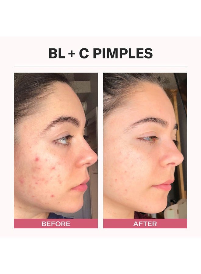 Odacite Odacité Acne Serum Concentrate for Face, Pore Cleanser Facial Oil for Pimples with Black Cumin + Cajeput - Purifying Facial Serum with Vitamin A & Natural Ingredients - 0.17 Fl. Oz - Image 5