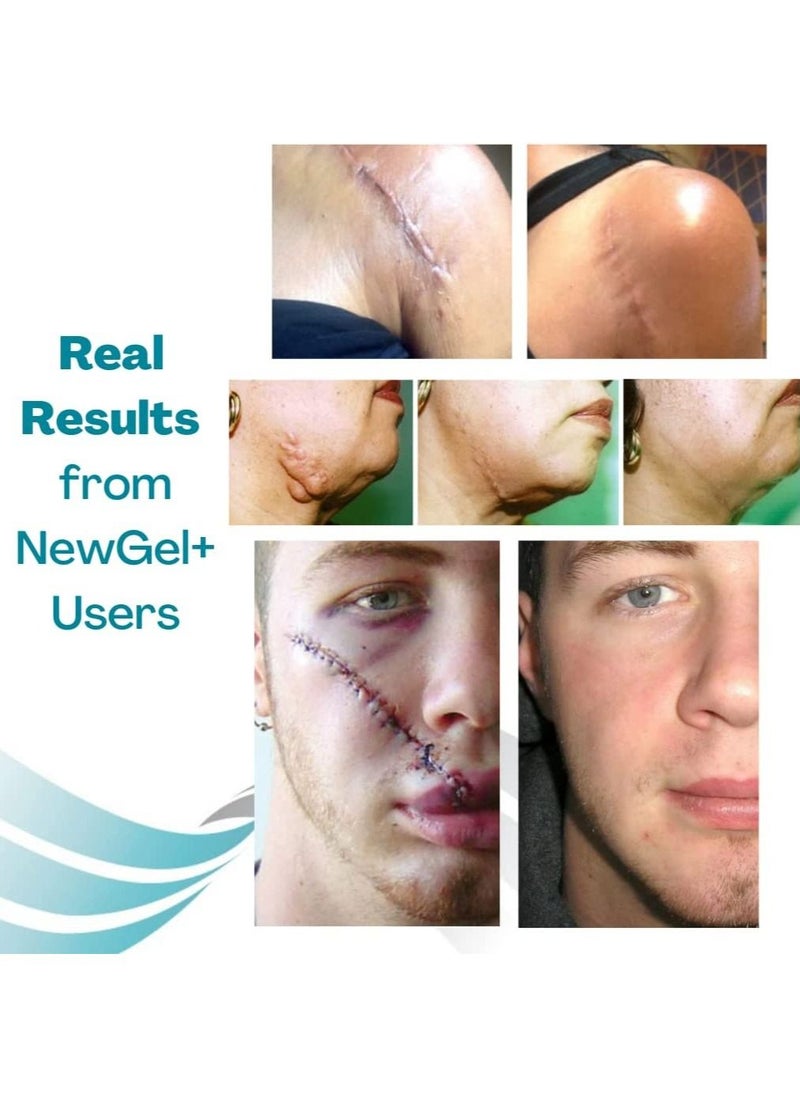 NewGel+ Silicone Strips for Scars Removal - Clear 2 Piece 5 x 20 cm  - Image 5