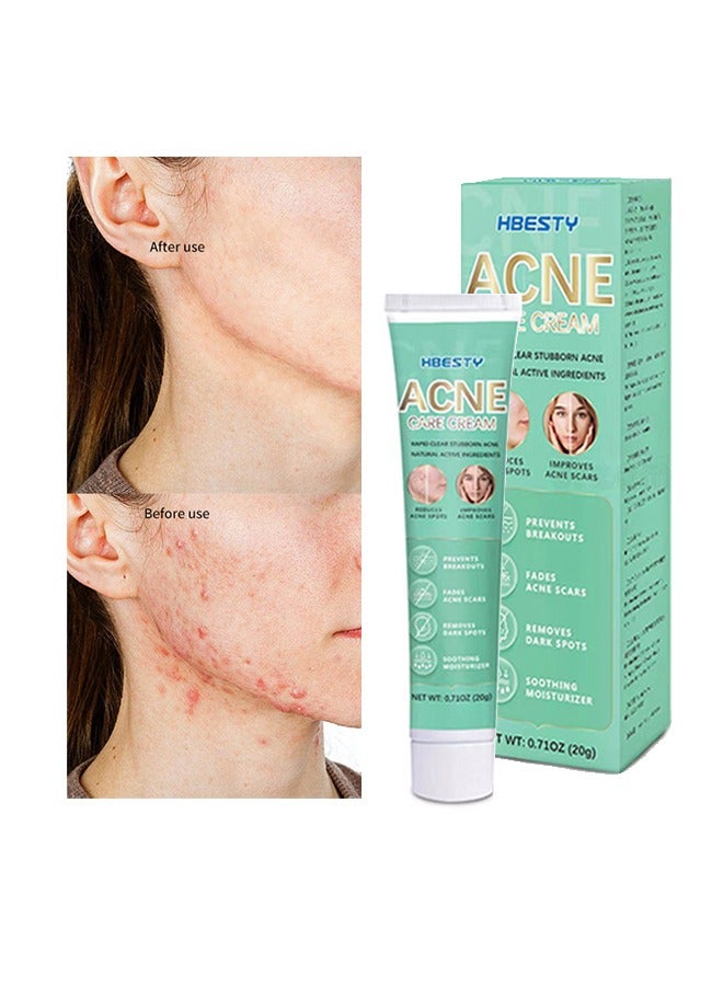 HBESTY Acne Care Cream，Oil Control Anti Acne Facial Care ，Acne Spot ，Cystic Acne，Fungal Acne ，Face Acne Spot Treatment and Acne Scar Treatment Post Acne Marks Treatment，Pimple Remover， Acne Repair  20g - Image 5