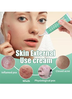 HBESTY Acne Care Cream，Oil Control Anti Acne Facial Care ，Acne Spot ，Cystic Acne，Fungal Acne ，Face Acne Spot Treatment and Acne Scar Treatment Post Acne Marks Treatment，Pimple Remover， Acne Repair  20g  - Image 2