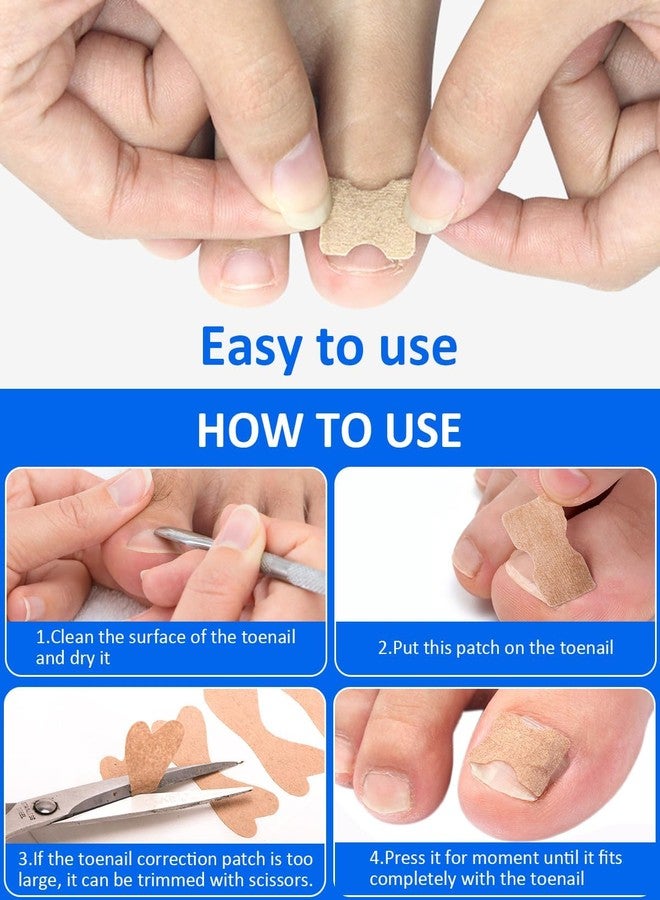 squishy 102Pcs Ingrown Toe Nail Remover, Ingrown Toenail Correction Tool Kit, Include Toenail Corrector Strips, Filling Pads and Nail Lifter for Daily Foot Care, Travel Essential - Image 3
