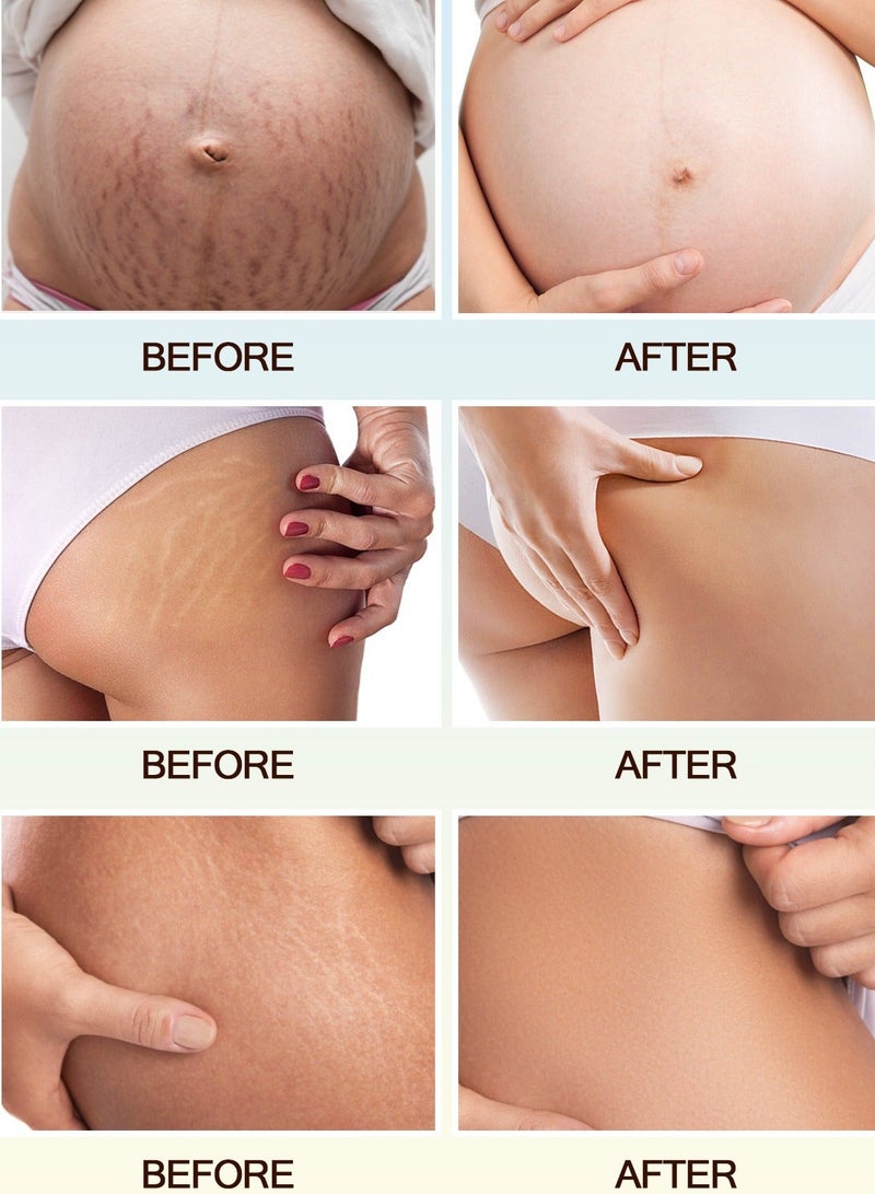 MOOYAM Stretch Marks Oil Natural for Pregnant Scars Repair Prevents and Lighten Stretch Marks Improves Skin Elasticity and Dullness for Women and Men 100ml - Image 5