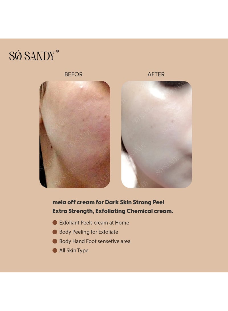 So Sandy Mela Off Cream Cold Peel 5 gm - (one session) - Image 3