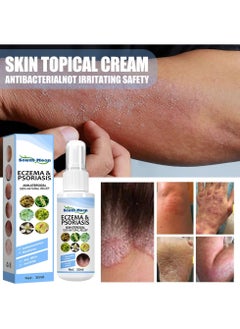 SOUTH MOON Herbal Psoriasis Relief Spray, Safe And Effective Eczema Soothing Spray, Simple And Convenient Herbal Psoriasis Soothing Mist, Quick Application Vitiligo Removal Relief For All Skin Types  - Image 4
