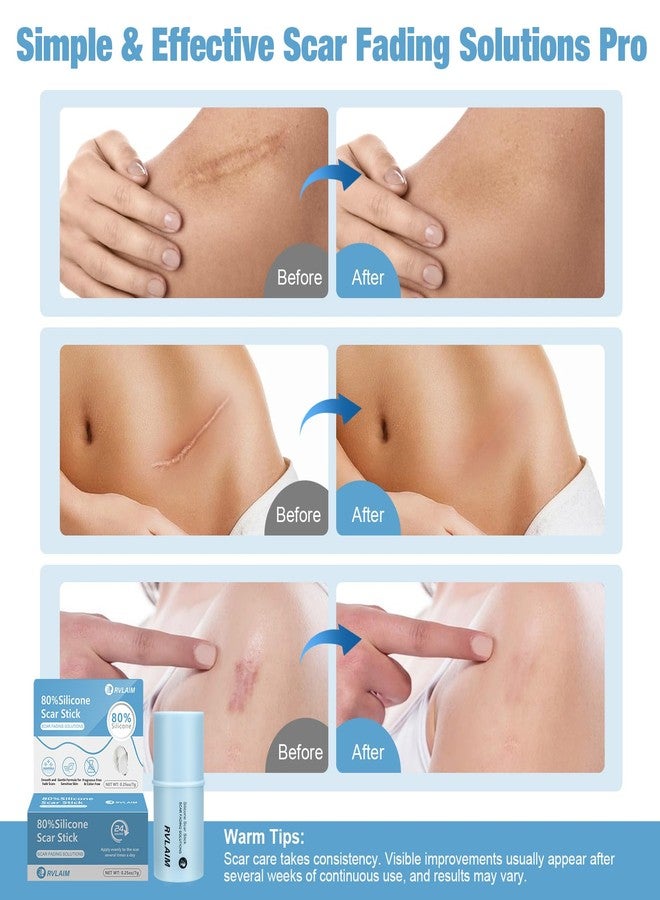 Rvlaim Silicone Scar Stick, 80% Silicone Stick for Face and Body. Silicone Stick for Removal of Surgical,Old and Recent Scars and Stretch Marks - 7g - Image 5