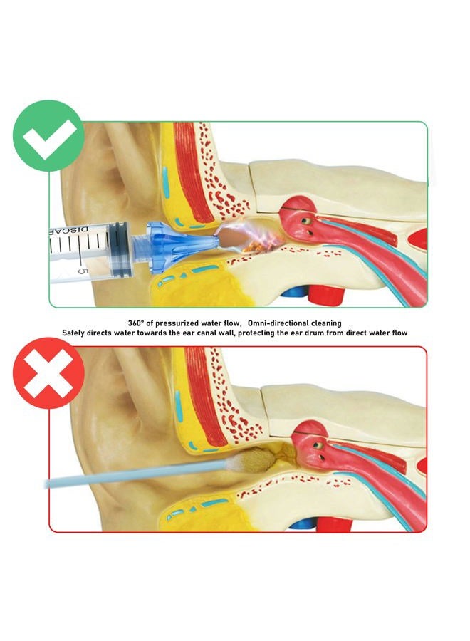 ETTSNU 20mL Ear Syringes for Removing Ear Wax, Cleaning Water Irrigation Kits with 3 Penta-Stream Tips and 3 Tri-Stream Tips Improved Hearing Clarity and Aural Hygiene (clear) - Image 2