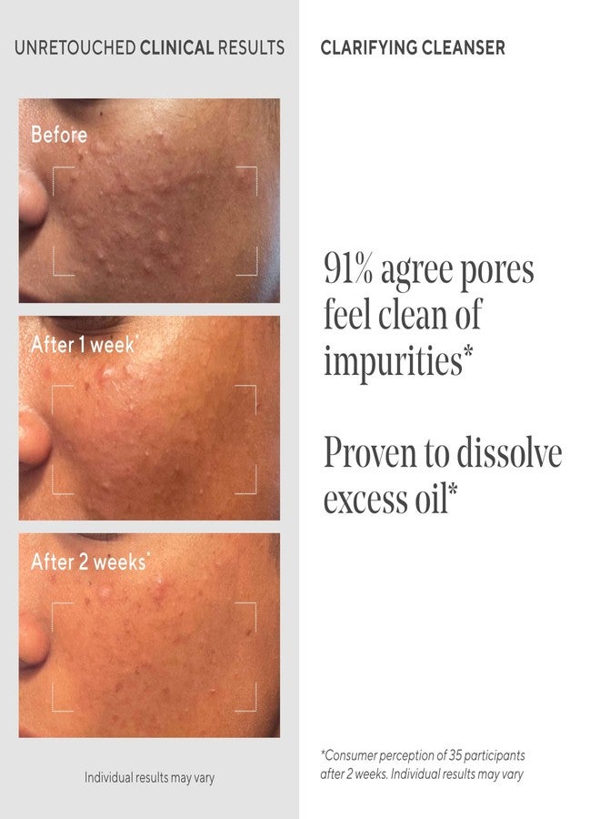 Murad Clarifying Cleanser - Salicylic Acid & Green Tea Formula for Acne, Deep Pore Cleansing, Oil Control & Breakout Prevention for Clear, Balanced, Healthy-Looking Skin - 5 Fl Oz - Image 4