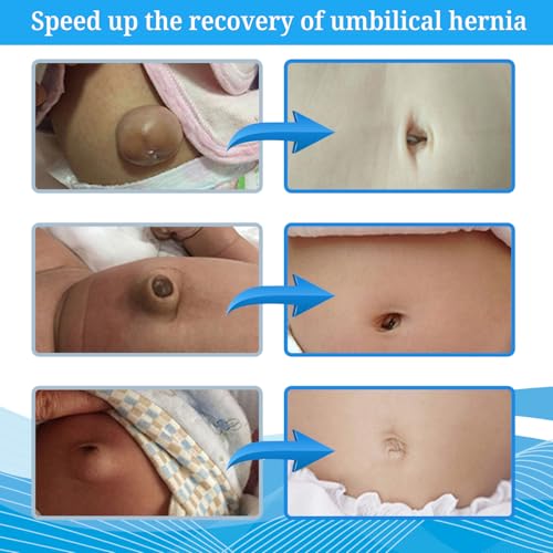 Ççs S Baby Belly Band Umbilical Hernia Belt | Belly Button Band Navel Truss Wrap for Newborn/Infant - Soft, Skin-friendly, Adjustable - Image 2