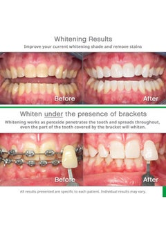 Opalescence Go 10% - Prefilled Teeth Whitening Trays Kit (10 Treatments) - 10% Hydrogen Peroxide - Mint Made by Ultradent Products. Go Teeth Whitening Kit -Mint- GO10-5193-1  - Image 3