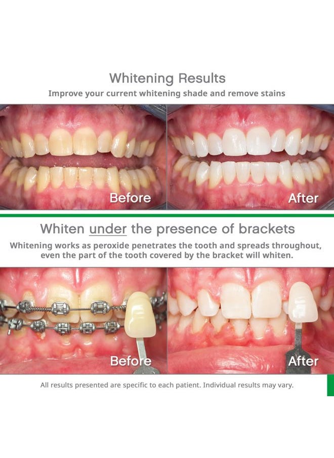 Opalescence Go 10% - Prefilled Teeth Whitening Trays Kit (10 Treatments) - 10% Hydrogen Peroxide - Mint Made by Ultradent Products. Go Teeth Whitening Kit -Mint- GO10-5193-1  - Image 3