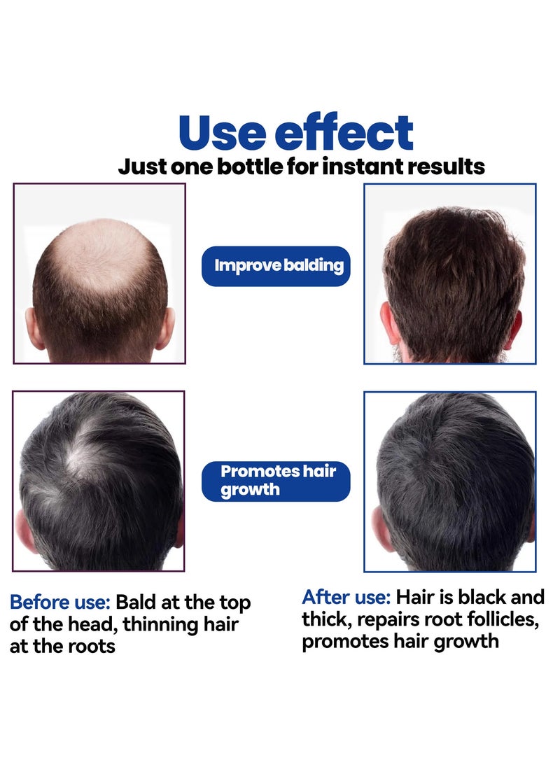 East Moon - Man Hair Growth Spray ，Dense Growth Hair，Chest Hair ，Beard Hair Growth  Nutrient Solution，Alopecia Hair Growth Treatment for Sparse Hair ﻿,Minoxidil Promote Hair Follicle Growth Trigger New Hair Growth - Image 1