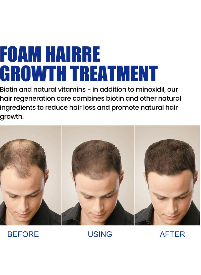 East Moon - Man Hair Growth Spray ，Dense Growth Hair，Chest Hair ，Beard Hair Growth  Nutrient Solution，Alopecia Hair Growth Treatment for Sparse Hair ﻿,Minoxidil Promote Hair Follicle Growth Trigger New Hair Growth - Image 1