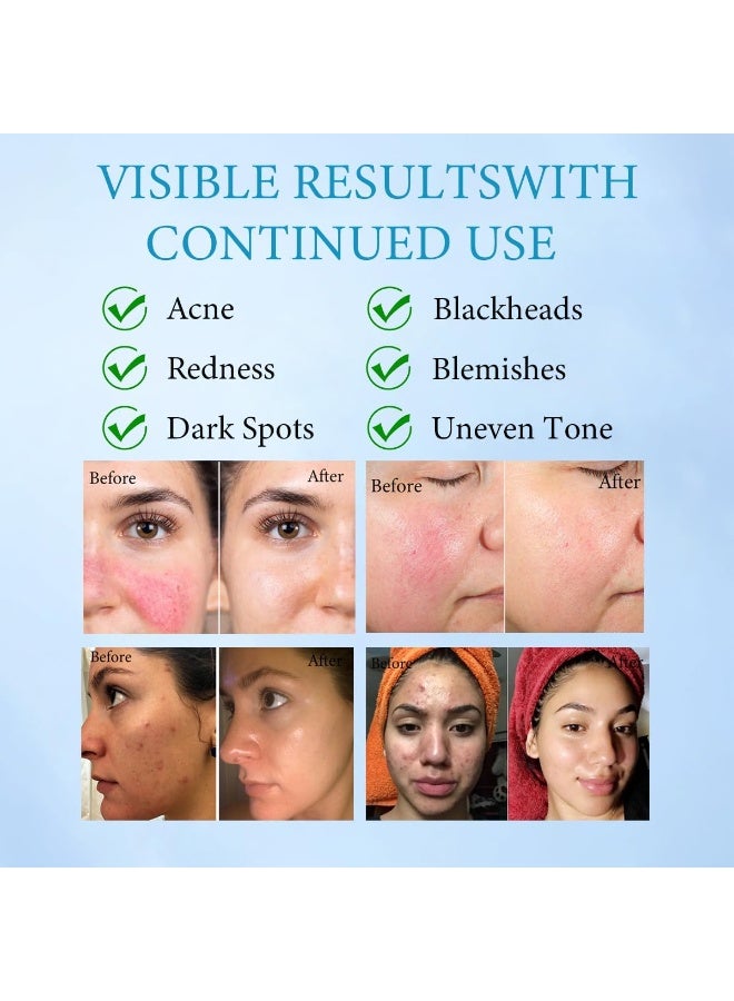 SKQIR 14% Azelaic Acid Acne Cream for Face,Advanced Azelaic Acid Serum,Redness Relief for Face, Redness Reducing Skin Care,Blackheads,Blemishes，Uneven Tone,30g - Image 3