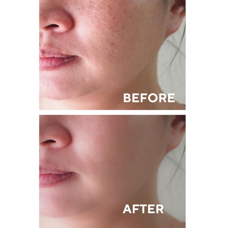 the CEEL Facial Peeling Serum With 10 AHA 2 BHA Saliscylic Acid Serum for Blemishes Chemical Peel at Home Glycolic Acid Peel With Hyaluronic AcidAHA and BHA 100 floz 30 ml - Image 3