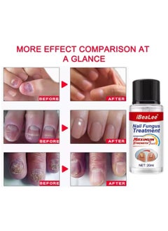 iBealee Nail Fungus treatment 7 Day Nail Repair Treatment Liquid for Damaged Toenails and Fingernails Fungal Nail Renewal Anti Fungus Nail Repair Smooth Moisturize Nail Reduce Discoloration Nail Serum 20ml  - Image 3