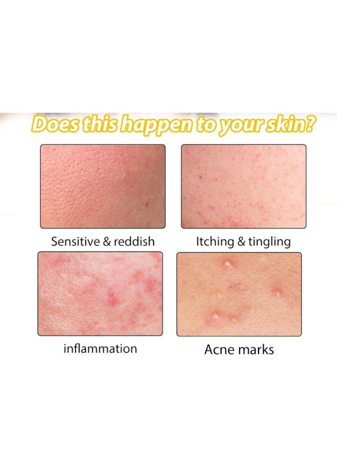 EELHOE Ultimate Cystic Acne Removal Cream – Anti-Bacterial Soothing Moisturizer & Scar Repair Support for Youthful Clear Skin - Image 4