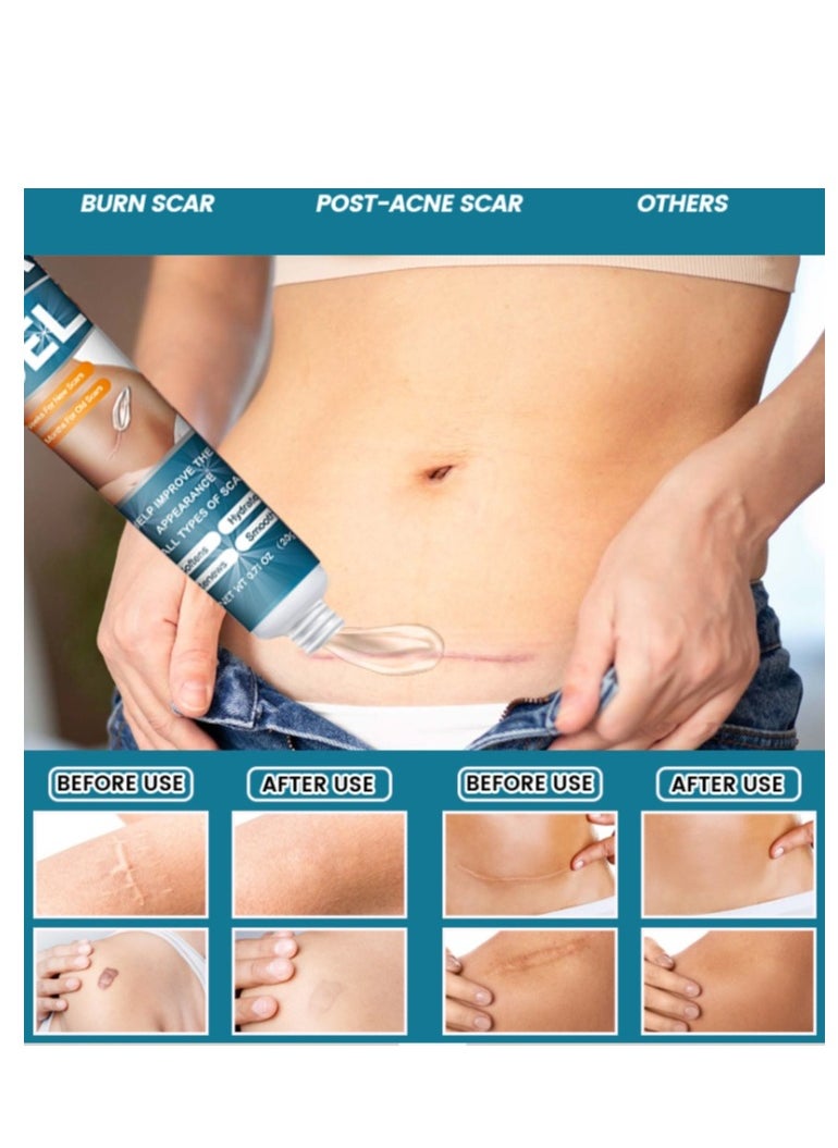 Scar Gel 20g Effective In Treating Scars C-Section Scars Stretch Marks Acne Surgery Burns Effective On Old And New Scars