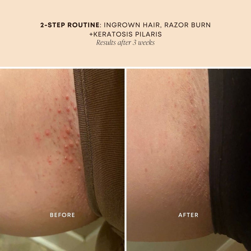Bushbalm Ingrown Hair Oil - Helps With Ingrown Hair, Underarm Bumps, Soothes Razor Bumps, Post Shave Redness and Itching - 30ml Sweet Escape - Image 5