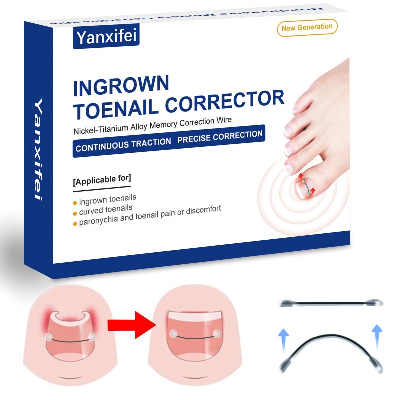 Yanxifei Nitinol Ingrown Toenail Corrector,at Home Ingrown Toenail Treatment,Curved Toenail Straightener,Ingrown Toe Nail Reliefï¼ŒIngrown Toenail Removal Kit (11/16 In,13/16 In) - Image 1