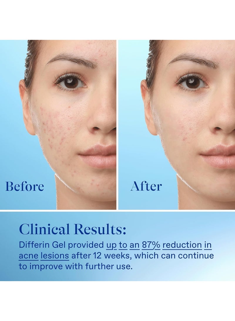 ديفرين هلام علاج حب الشباب ، إمدادات 90 يومًا ، علاج الرتينويد للوجه مع 0.1٪ Adapalene ، العناية بالبشرة اللطيفة للبشرة الحساسة المعرضة للحب الشباب ، مضخة 45 غرام (قد تختلف التعبئة والتغليف) - Image 5