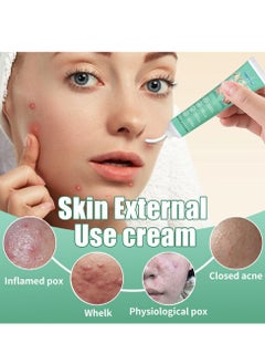 HBESTY Acne Treatment Face Cream，Oil Control Anti Acne Facial Care ，Acne Spot ，Cystic Acne，Fungal Acne ，Face Acne Spot Treatment and Acne Scar Treatment  Post Acne Marks Treatment，Pimple Remover， Acne Repair  - Image 2