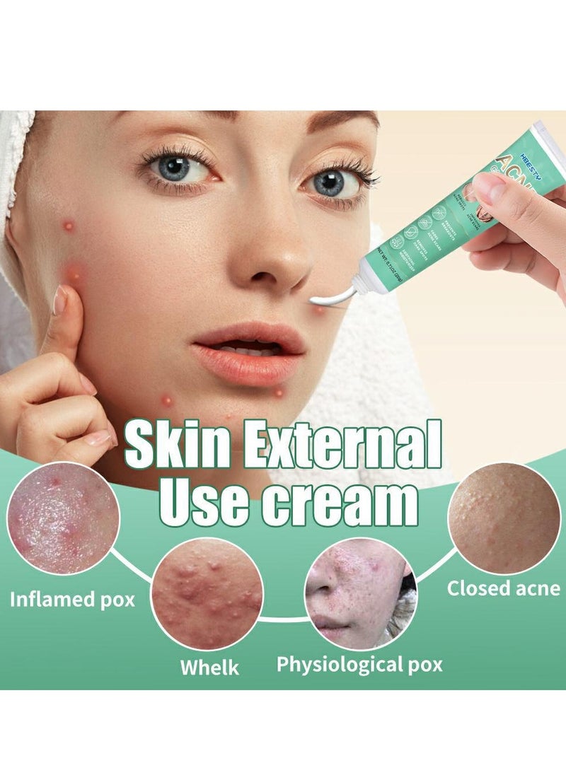 HBESTY Acne Treatment Face Cream，Oil Control Anti Acne Facial Care ，Acne Spot ，Cystic Acne，Fungal Acne ，Face Acne Spot Treatment and Acne Scar Treatment  Post Acne Marks Treatment，Pimple Remover， Acne Repair  - Image 2