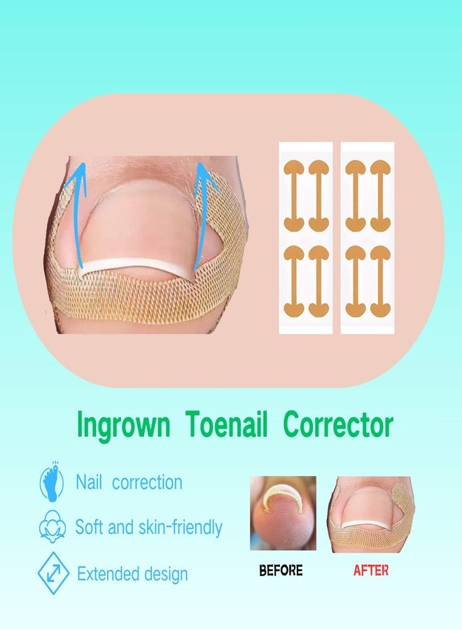 مجموعة SunOutDeeal لعلاج الأظافر الغائرة مع رقعة تصحيح منحنية، طقم إزالة أظافر مطور، أدوات للعناية بالقدمين في المنزل - Image 3