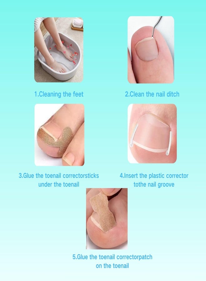 مجموعة SunOutDeeal لعلاج الأظافر الغائرة مع رقعة تصحيح منحنية، طقم إزالة أظافر مطور، أدوات للعناية بالقدمين في المنزل - Image 4