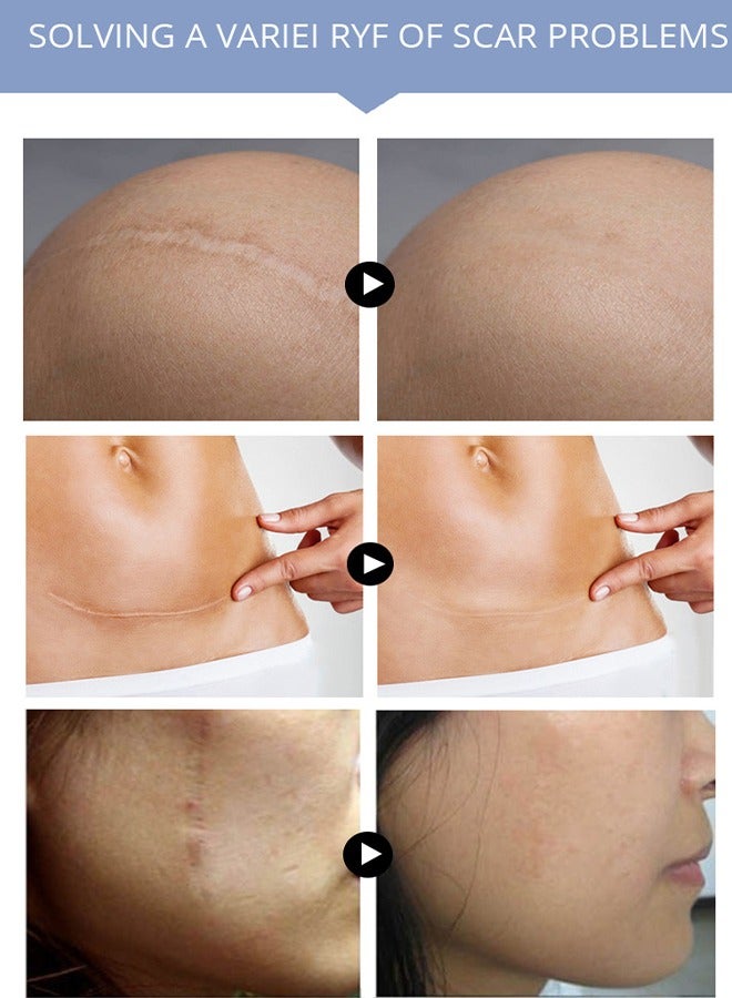 MSLAM Scar Repaie Gel, scar Removal Gel Suitable For New And Old Scars On Cuts, Stretch Marks,Face And Body Burn Recovery Gel (20g) - Image 4