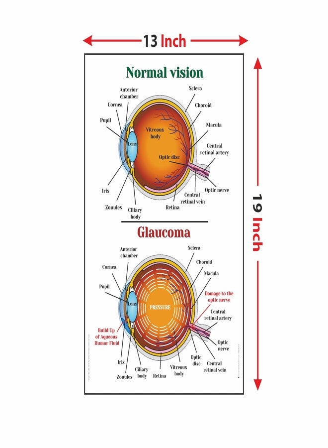 Anne Print Solutions® Normal Vision Glaucoma Poster 13 X 19 Inch (Without Frame) for Hospital | Clinic Pack of 1 Pcs Multicolor - Image 2