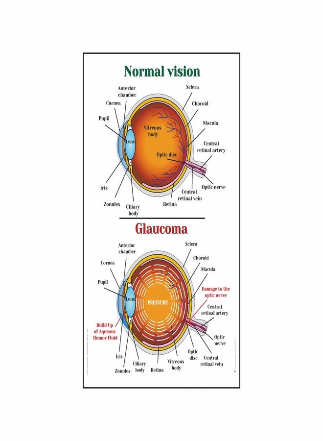 Anne Print Solutions® Normal Vision Glaucoma Poster 13 X 19 Inch (Without Frame) for Hospital | Clinic Pack of 1 Pcs Multicolor - Image 1