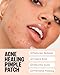 PEACE OUT Acne Day & Night Duo, Invisible Hydrocolloid Pimple Patches for Daytime + Healing Overnight Acne Dots, Clear Blemishes Fast with 2% Salicylic Acid (20 count) - Image 3