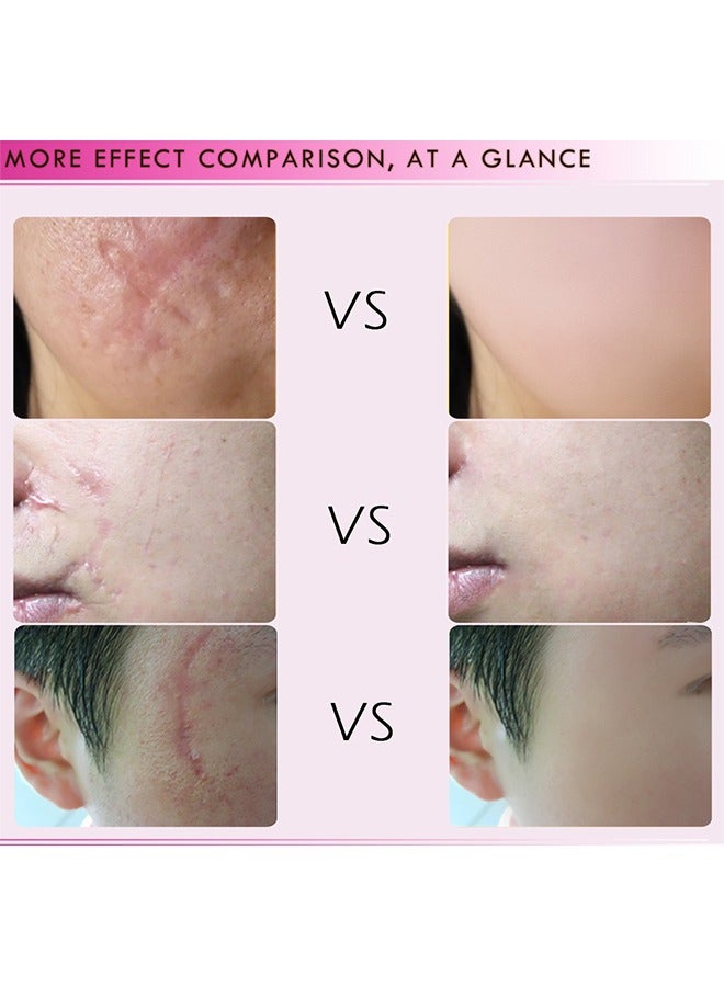 آر توب آر كريم مانجو للعناية بالبشرة ، إزالة الندبات ، إصلاح الندبات ، إصلاح البشرة ، علاج علامات التمدد ، حب الشباب ، العناية الجراحية 15 جرام - Image 4