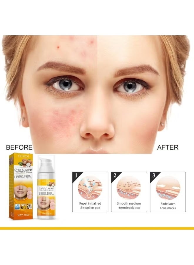 إيلهو كريم علاج مكثف لحب الشباب 30 مل، يُصلح حب الشباب الكيسي، ويرطب البشرة، ويُصغّر المسام للحصول على بشرة أكثر نقاءً بشكل عام. - Image 5