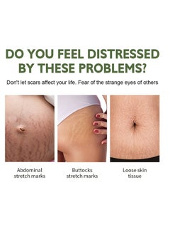 MOOYAM Stretch Mark Cream For Women (120Gm Pack Of 1) Scar Removal And Moisturizing Cream Stretch Mark Removal For Stomach Thighs And All Body Parts  - Image 2