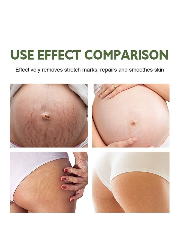 MOOYAM Stretch Mark Cream For Women (120Gm Pack Of 1) Scar Removal And Moisturizing Cream Stretch Mark Removal For Stomach Thighs And All Body Parts - Image 3