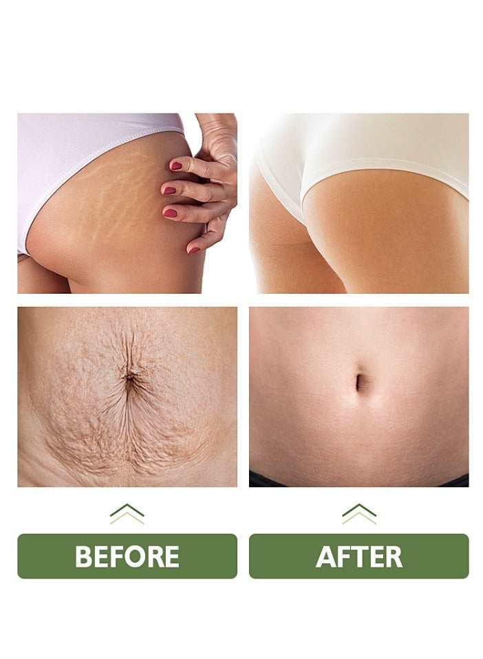 MOOYAM Stretch Mark Cream For Women (120Gm Pack Of 1) Scar Removal And Moisturizing Cream Stretch Mark Removal For Stomach Thighs And All Body Parts - Image 4