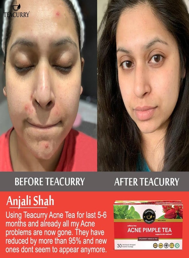 TEACURRY Tecurry Acne Pimple Tea (1 Month pack, 30 Tea Bags) - Helps with Skin Nnourishment, Reducing Pimples & Fighting pigmentation | Acne Tea - Green Tea Pimple Remover - Image 2