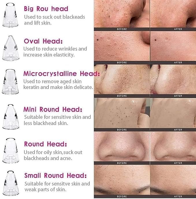 GABANIZ GABANIZ 6 in 1 Multifunction Blackhead Remover Tools  Electric Derma suction Machine  USB Rechargeable Acne Pimple Pore Cleaner Vacuum tool  Facial Cleanser Device for Nose  Skin Care  - Image 3