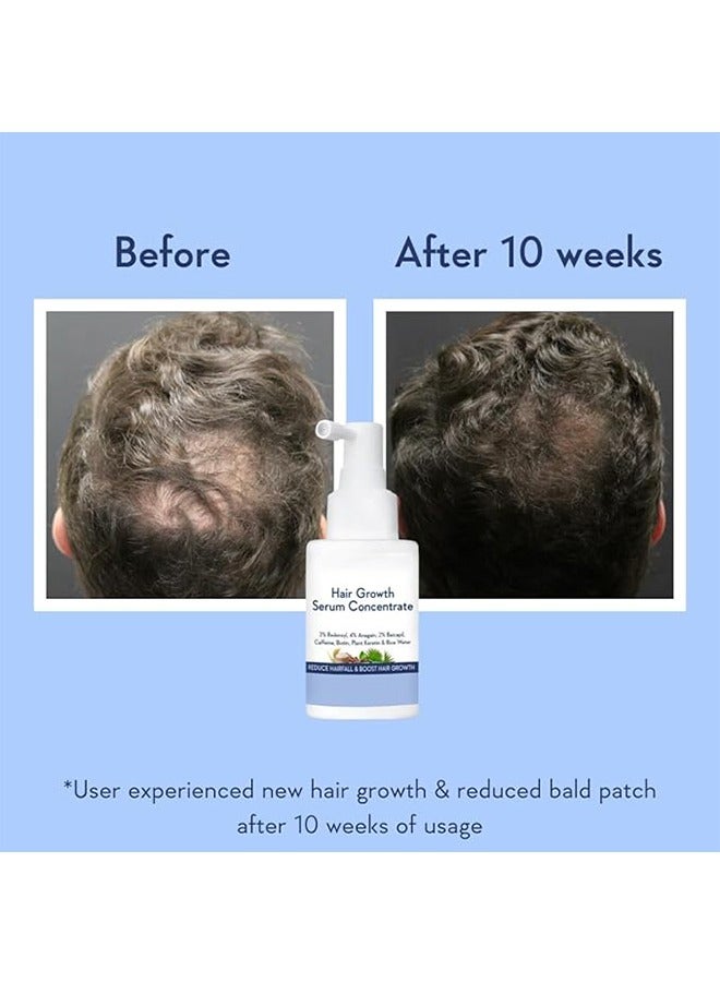 Hair Growth Serum Concentrate 30ml, 3% Redensyl, 4% Anagain, 2% Baicapil, Caffeine, Biotin, Plant Keratin & Rice Water, Reduce Hairfall, Boost Hair Growth for Men and Women