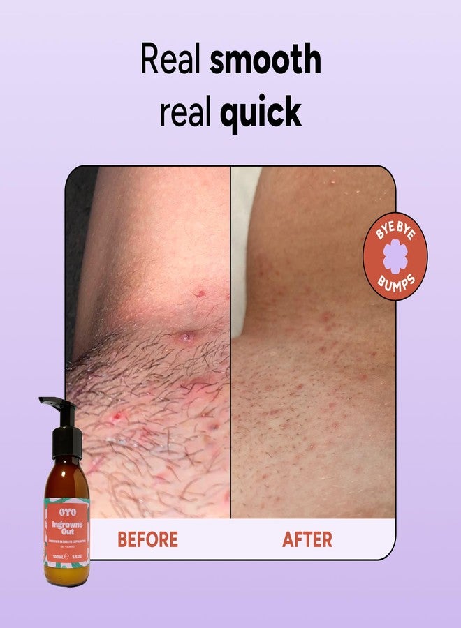 oyo Ingrowns Out by OYO – Ingrown Hair Scrub for Bikini Area & Underarms, Gentle Exfoliating Cream for Razor Bumps, Sensitive Skin Formula, 97% Natural, Fragrance?Free, 100 mL - Image 3