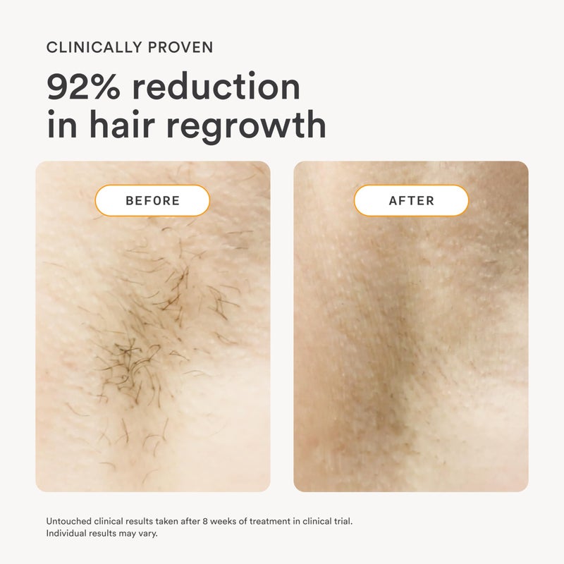 Nood NEW Nood™ Flasher 2.0 Kit — IPL Laser Hair Removal Device for Women & Men — Pain-free & Permanent, Visible Results After First Use & Works Everywhere — Pre & Post IPL Treatment Included — Matte Black - Image 3